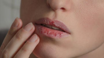 Mujer con los labios secos y agrietados