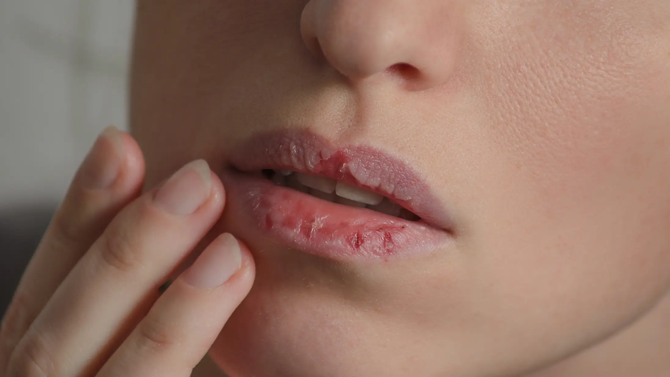 Mujer con los labios secos y agrietados Mujer con los labios secos y agrietados