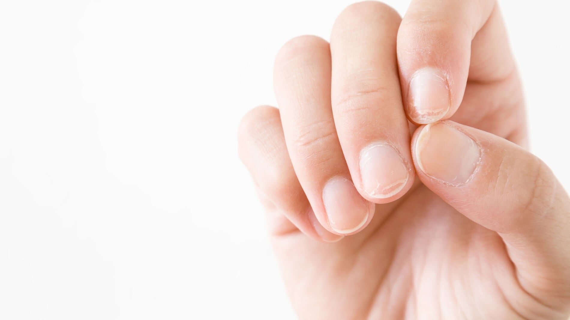 U&ntilde;as quebradizas