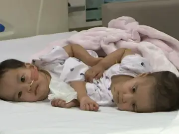 Las siamesas de Bután han sido separas con éxito en Australia Las siamesas de Bután han sido separas con éxito en Australia