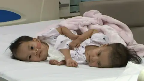 Las siamesas de Bután han sido separas con éxito en Australia Las siamesas de Bután han sido separas con éxito en Australia