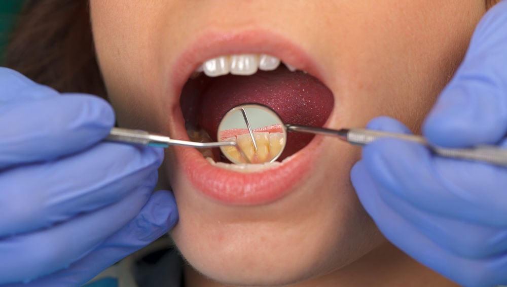 Como puedo eliminar el sarro dental en casa