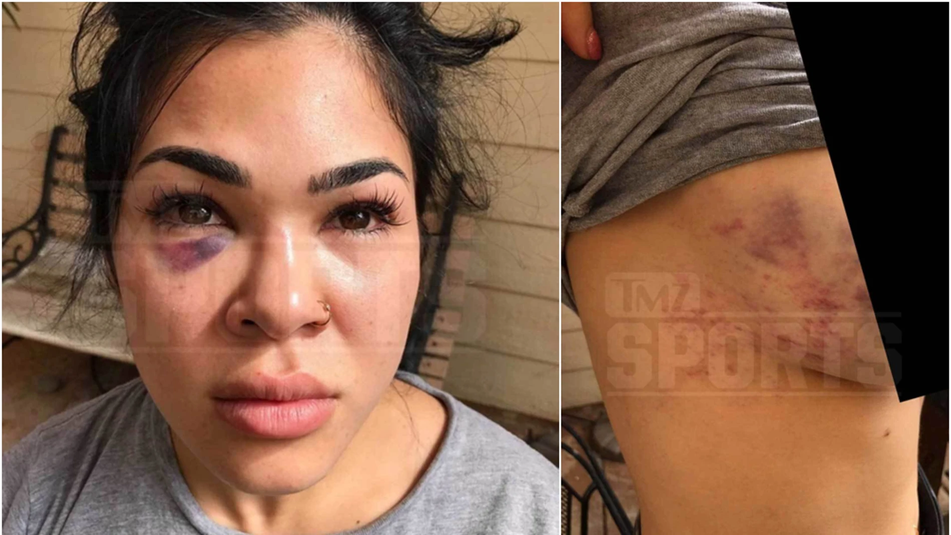 Rachael Ostovich muestra sus heridas tras la agresión de su marido Rachael Ostovich muestra sus heridas tras la agresión de su marido