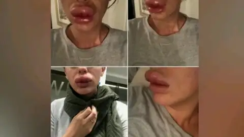 Los daños que causa la moda de las fiestas del bótox Los daños que causa la moda de las fiestas del bótox