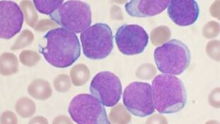 leucemia linfoide aguda