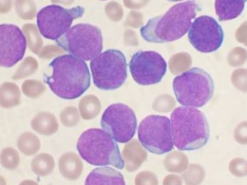 leucemia linfoide aguda