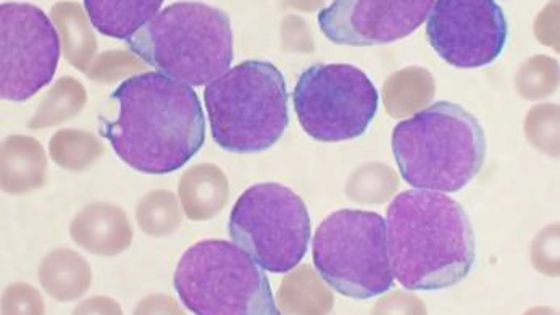 leucemia linfoide aguda leucemia linfoide aguda