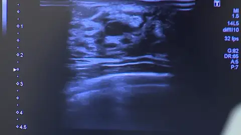 Muere una mujer de cáncer dos años después de que le olvidaran citarla para el diagnóstico de un bulto Muere una mujer de cáncer dos años después de que le olvidaran citarla para el diagnóstico de un bulto