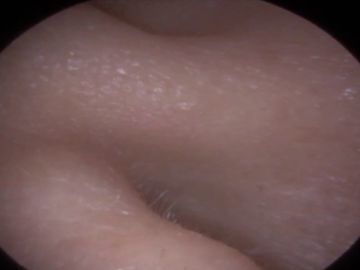 Encuentran extraño objeto dentro de su oreja Encuentran extraño objeto dentro de su oreja