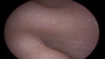Encuentran extraño objeto dentro de su oreja Encuentran extraño objeto dentro de su oreja