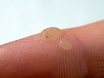 Verrugas en los dedos Verrugas en los dedos