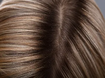 Cabello con caspa Cabello con caspa