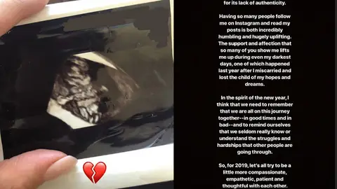 Ecografía del aborto de Shay Mitchell que compartió en sus historias de instagram Ecografía del aborto de Shay Mitchell que compartió en sus historias de instagram