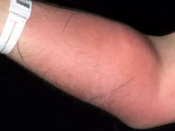 El brazo del paciente El brazo del paciente