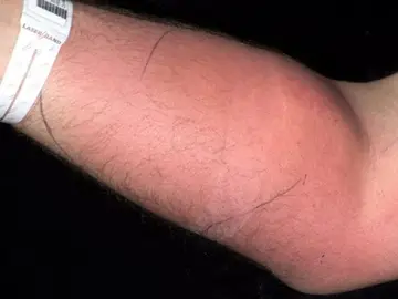 El brazo del paciente El brazo del paciente