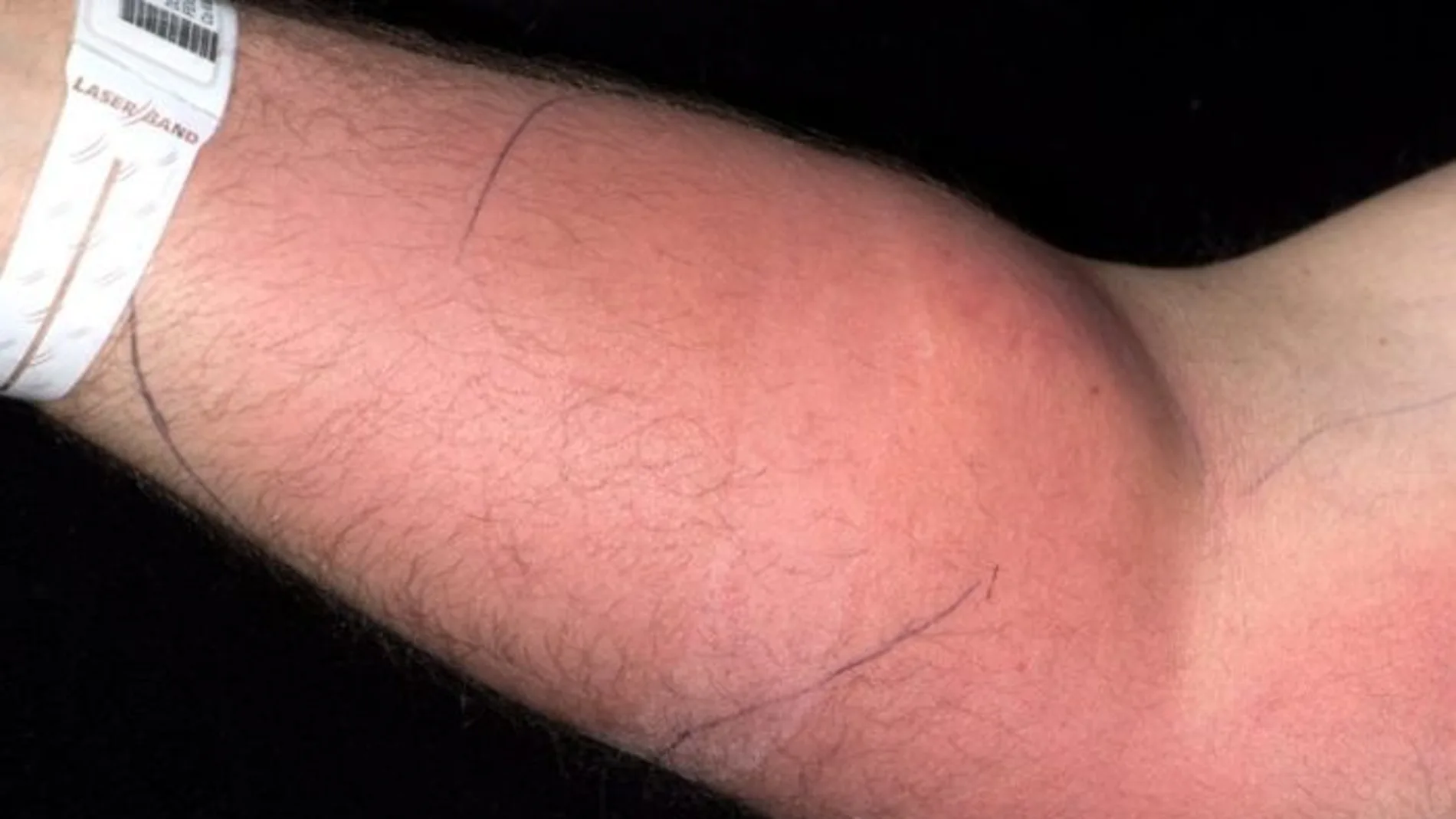 El brazo del paciente El brazo del paciente