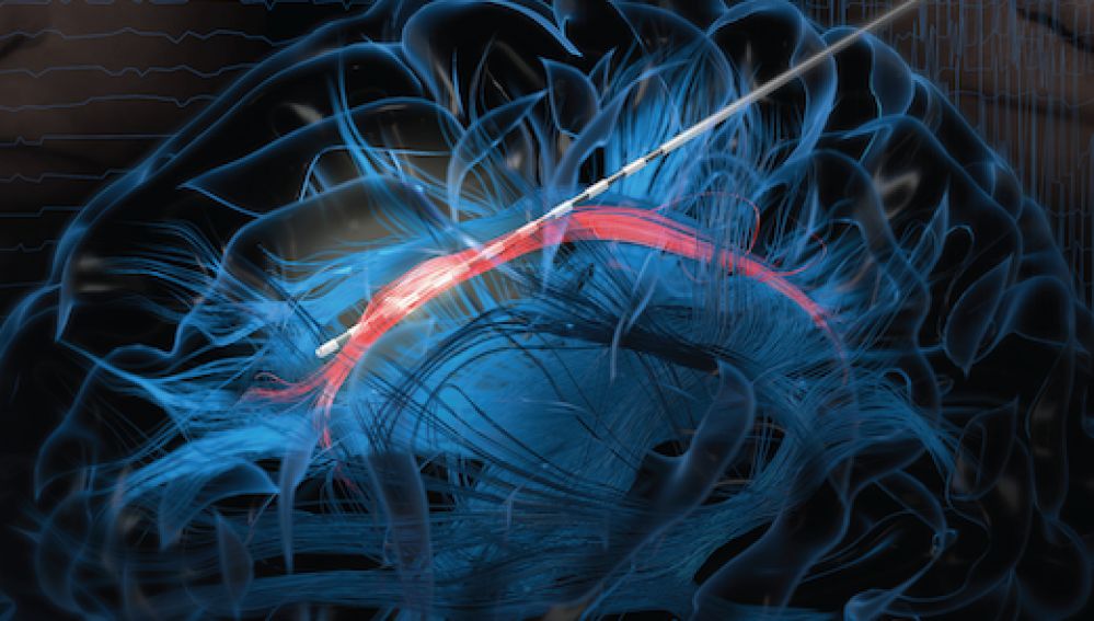  Imagen de un electrodo que estimula el giro cingulado del cerebro