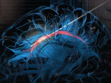 Imagen de un electrodo que estimula el giro cingulado del cerebro Imagen de un electrodo que estimula el giro cingulado del cerebro