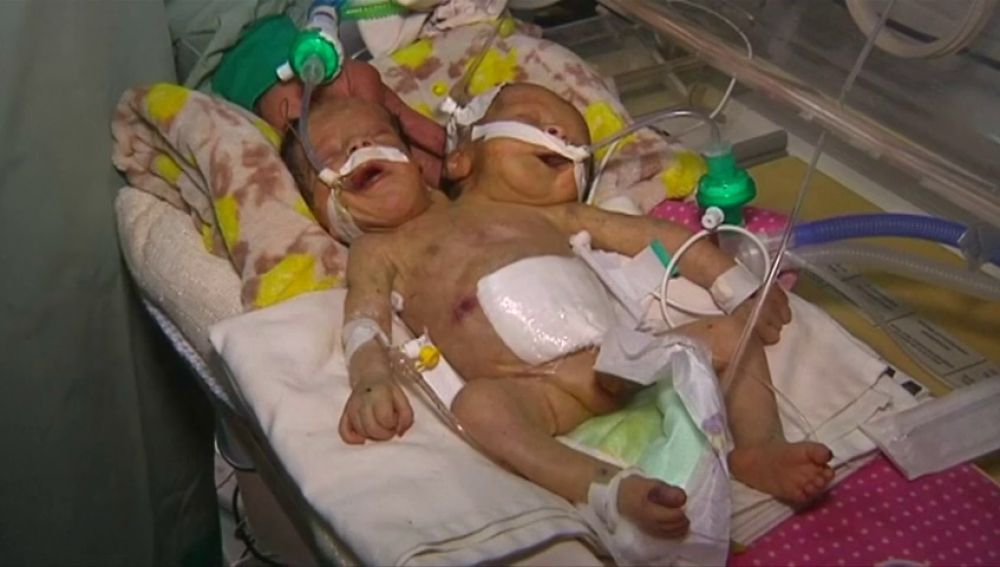 Médicos piden ayuda para trasladar a una pareja de hermanos siameses nacidos en Yemen