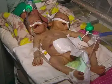 Médicos piden ayuda para trasladar a una pareja de hermanos siameses nacidos en Yemen Médicos piden ayuda para trasladar a una pareja de hermanos siameses nacidos en Yemen