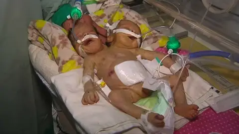 Médicos piden ayuda para trasladar a una pareja de hermanos siameses nacidos en Yemen Médicos piden ayuda para trasladar a una pareja de hermanos siameses nacidos en Yemen