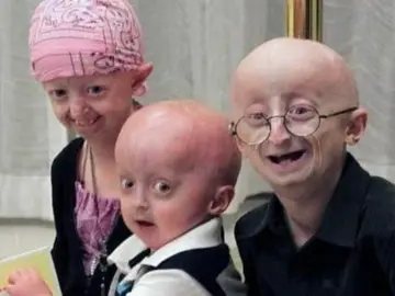 Hallan una terapia contra la progeria, la enfermedad que envejece a los niños Hallan una terapia contra la progeria, la enfermedad que envejece a los niños