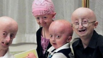 Hallan una terapia contra la progeria, la enfermedad que envejece a los niños