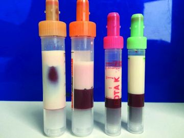 Ejemplo de exceso de triglic&eacute;ridos en la sangre