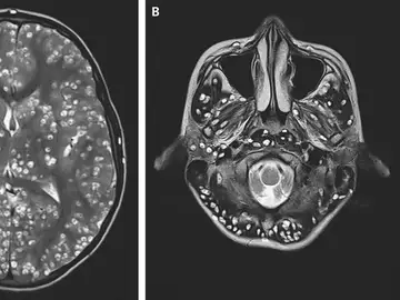 Cerebro del joven infectado con gusanos Cerebro del joven infectado con gusanos