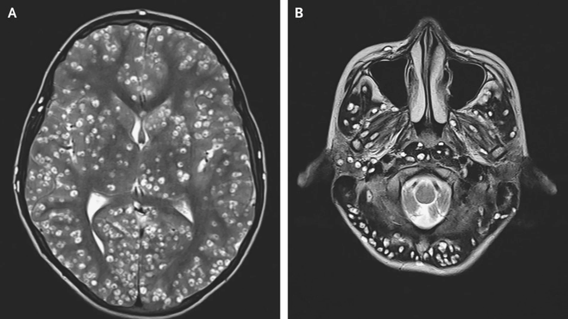 Cerebro del joven infectado con gusanos Cerebro del joven infectado con gusanos