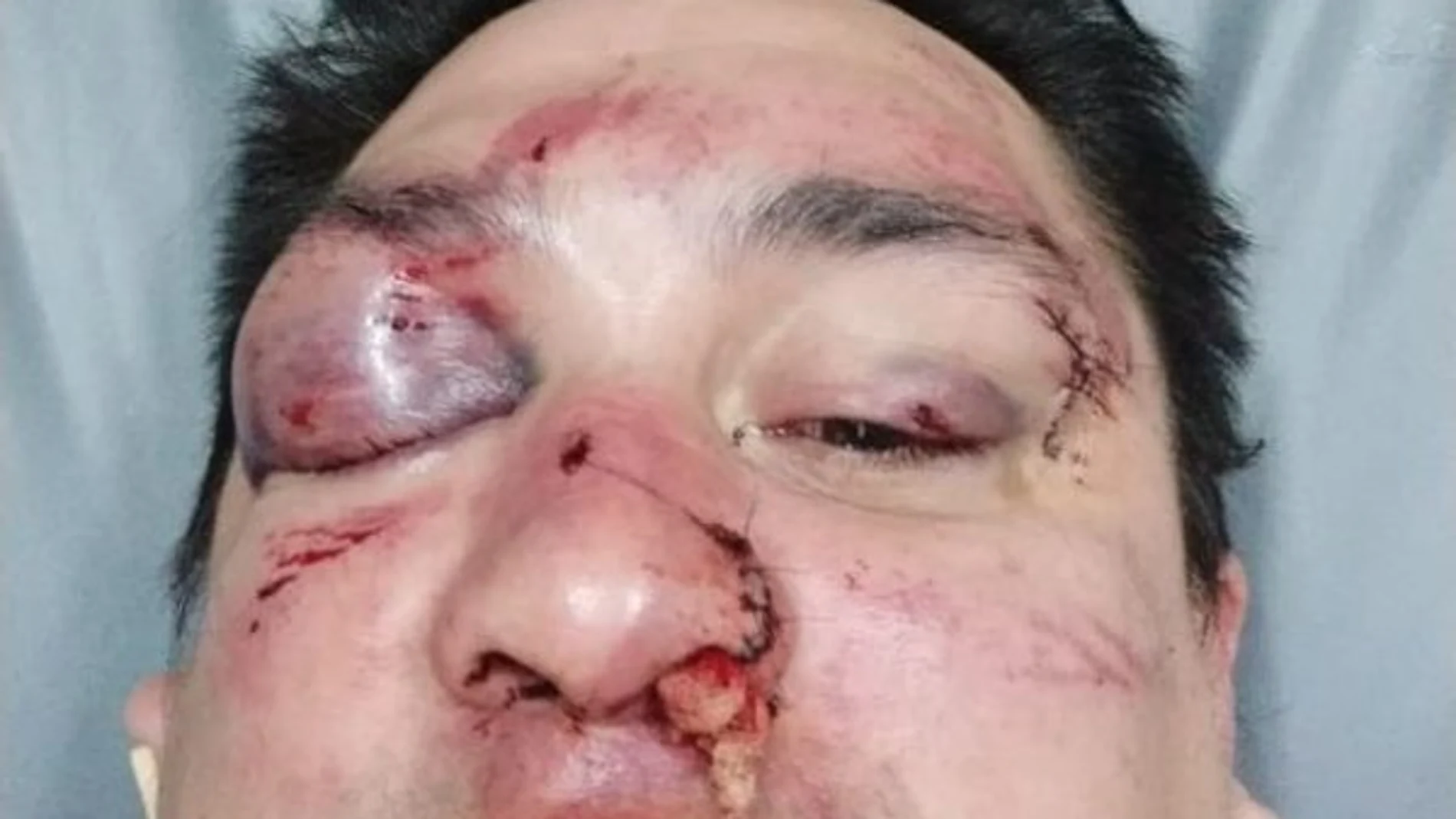 El periodista Sebastián Acosta, tras ser agredido El periodista Sebastián Acosta, tras ser agredido