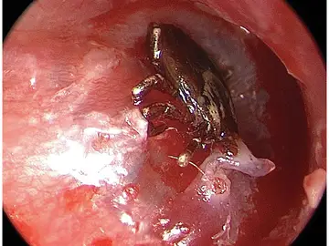 Imagen del tímpano con la garrapata Imagen del tímpano con la garrapata