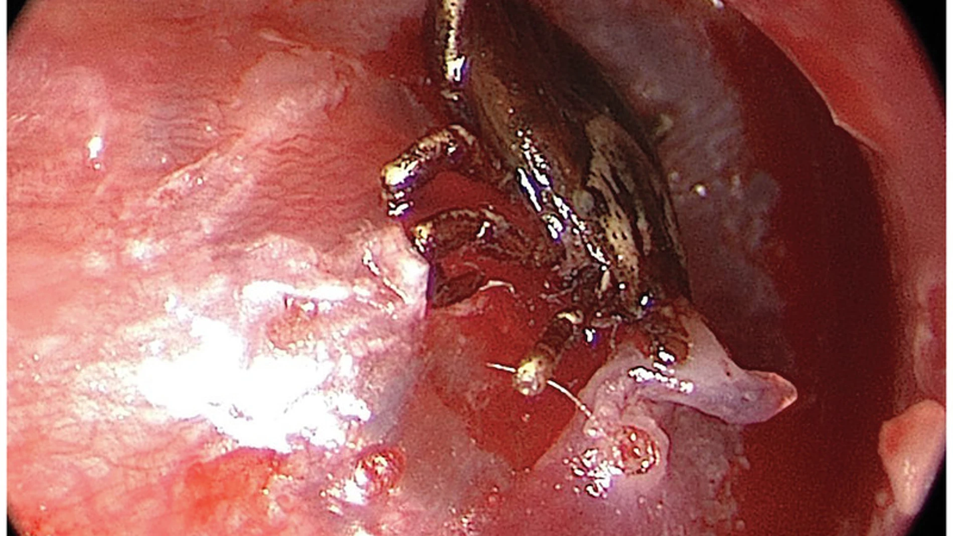 Imagen del tímpano con la garrapata Imagen del tímpano con la garrapata