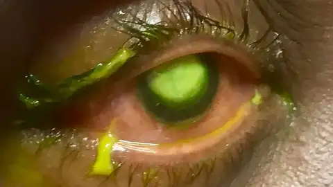 Las consecuencias de dormir con lentillas Las consecuencias de dormir con lentillas