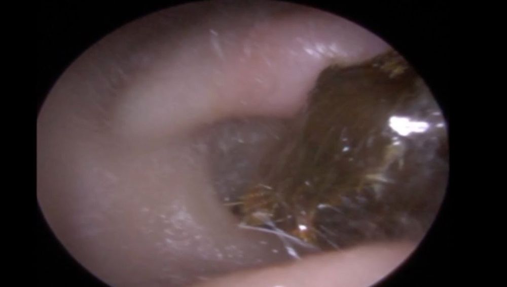 Sacar tapon de cera con agua