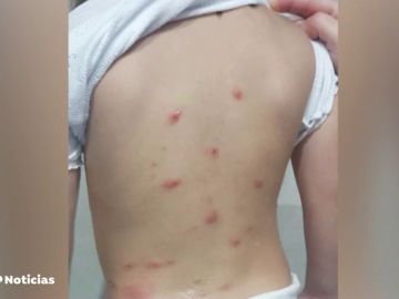 Cierra un colegio de Málaga por la aparición de una plaga de pulgas