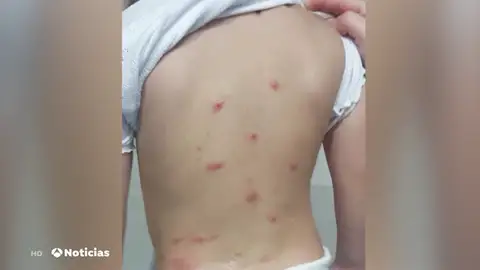 Cierra un colegio de Málaga por la aparición de una plaga de pulgas Cierra un colegio de Málaga por la aparición de una plaga de pulgas