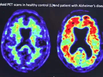 Pfizer ocultó que uno de sus fármacos contra la artritis podría prevenir el Alzheimer Pfizer ocultó que uno de sus fármacos contra la artritis podría prevenir el Alzheimer