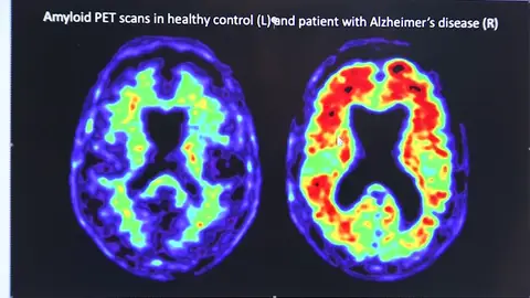 Pfizer ocultó que uno de sus fármacos contra la artritis podría prevenir el Alzheimer Pfizer ocultó que uno de sus fármacos contra la artritis podría prevenir el Alzheimer