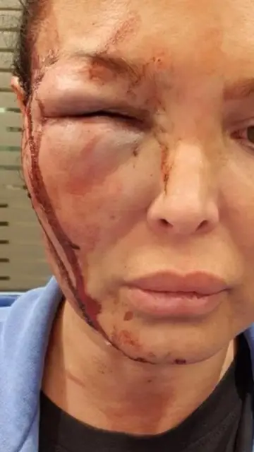 Manto Tzavaras enseña la presunta agresión de Papamakarios Manto Tzavaras enseña la presunta agresión de Papamakarios