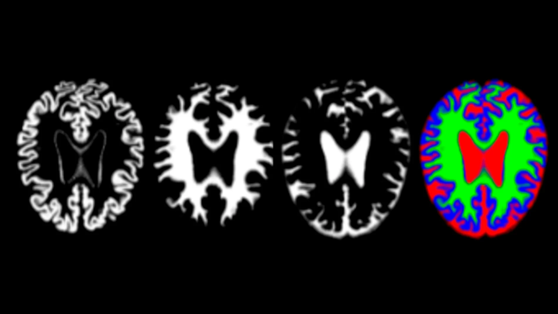 Imágenes de resonancia de cerebros con alzhéimer Imágenes de resonancia de cerebros con alzhéimer