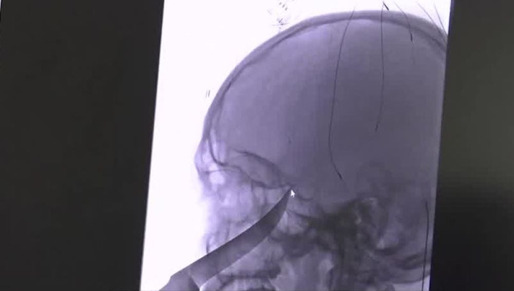 Radiografía del joven que se clava un cuchillo en la cara