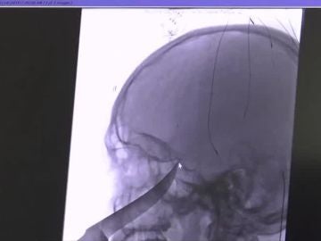 Radiografía del joven que se clava un cuchillo en la cara