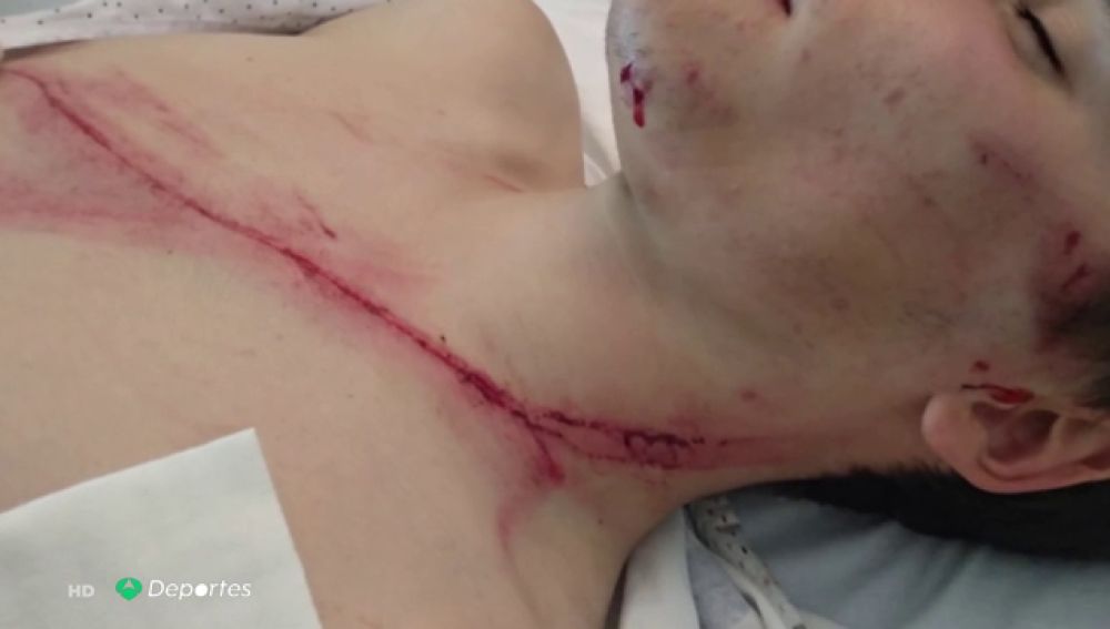 Dura imagen: la escalofriante herida de un ciclista que cayó sobre un guardarraíl