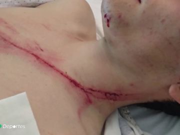 Dura imagen: la escalofriante herida de un ciclista que cayó sobre un guardarraíl