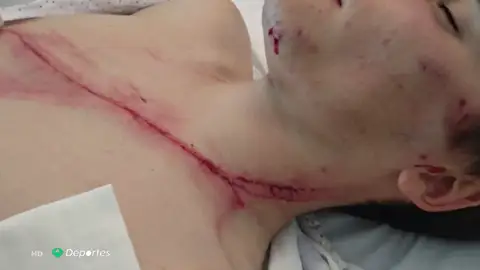 Dura imagen: la escalofriante herida de un ciclista que cayó sobre un guardarraíl Dura imagen: la escalofriante herida de un ciclista que cayó sobre un guardarraíl