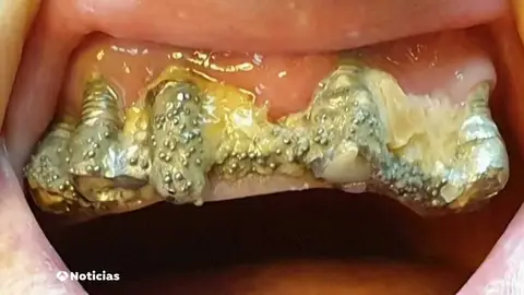 DENTADURA DENTADURA
