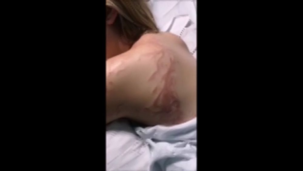 Una joven sufre una picadura de carabela portuguesa en Murcia: "Creía que me moría"
