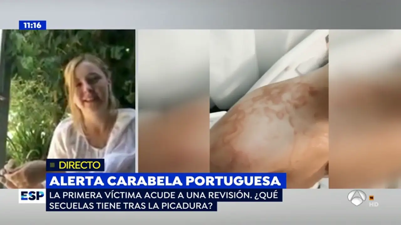 La primera afectada por la carabela portuguesa: "Me han dicho que las marcas nunca desaparecerán"