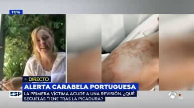 La primera afectada por la carabela portuguesa: 